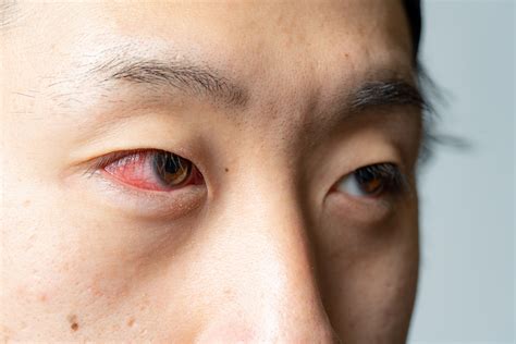 慢性結膜炎|結膜炎の症状は？原因や治るまでの期間、治療方法に。